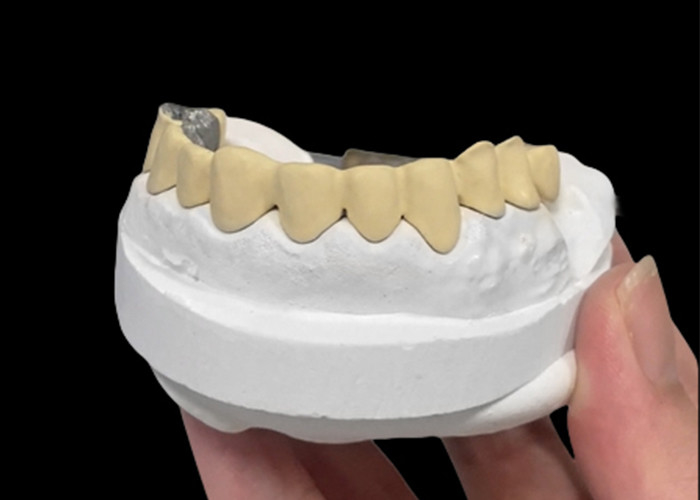 La porcelaine fondue dans une couronne métallique combine durabilité et beauté pour la santé dentaire
