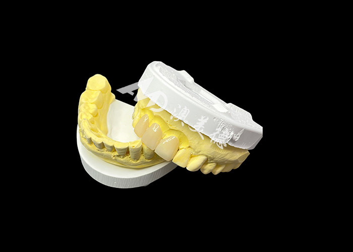 Améliorez votre esthétique dentaire avec un pont en céramique qui combine une esthétique exceptionnelle et une biocompatibilité exceptionnelle pour un sourire naturel et confortable