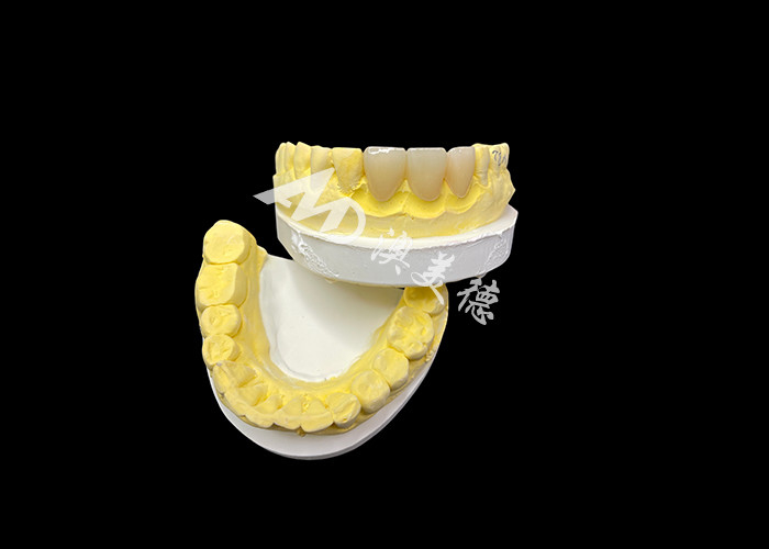 Améliorez votre esthétique dentaire avec un pont en céramique qui combine une esthétique exceptionnelle et une biocompatibilité exceptionnelle pour un sourire naturel et confortable