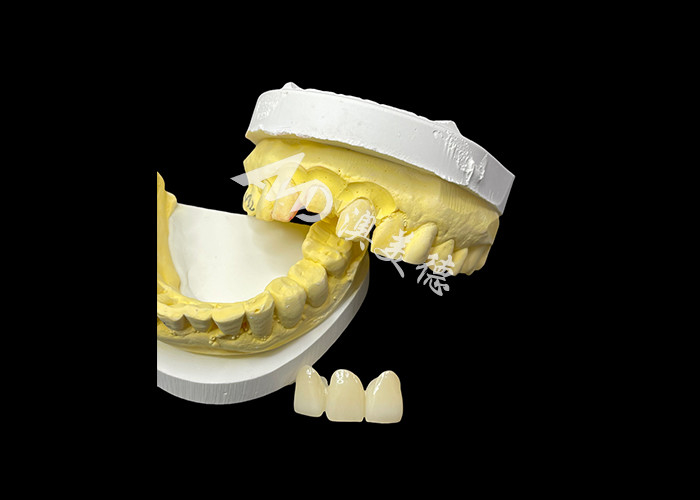 Améliorez votre esthétique dentaire avec un pont en céramique qui combine une esthétique exceptionnelle et une biocompatibilité exceptionnelle pour un sourire naturel et confortable