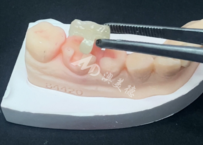 Les incrustations en céramique d'Emax sont utilisées pour la restauration dentaire pour une couleur naturelle des dents et un entretien facile.