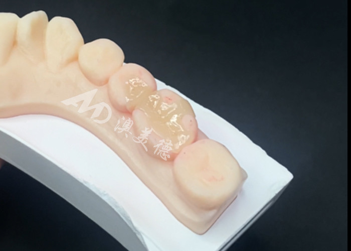 Les incrustations en céramique d'Emax sont utilisées pour la restauration dentaire pour une couleur naturelle des dents et un entretien facile.