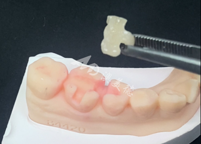 Les incrustations en céramique d'Emax sont utilisées pour la restauration dentaire pour une couleur naturelle des dents et un entretien facile.
