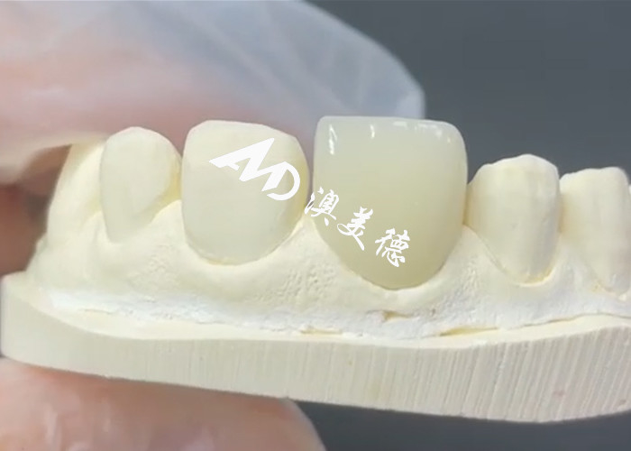 Veneur EMAX durable et esthétique La solution parfaite pour les restaurations de porcelaine