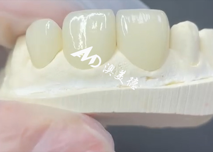 Veneur EMAX durable et esthétique La solution parfaite pour les restaurations de porcelaine