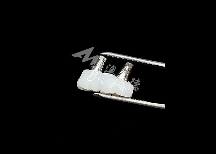 Des couronnes d'implants dentaires en zirconium avec un support en titane pour un confort et une esthétique améliorés