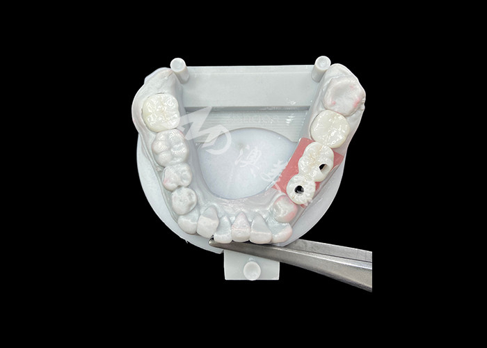 Des couronnes d'implants dentaires en zirconium avec un support en titane pour un confort et une esthétique améliorés