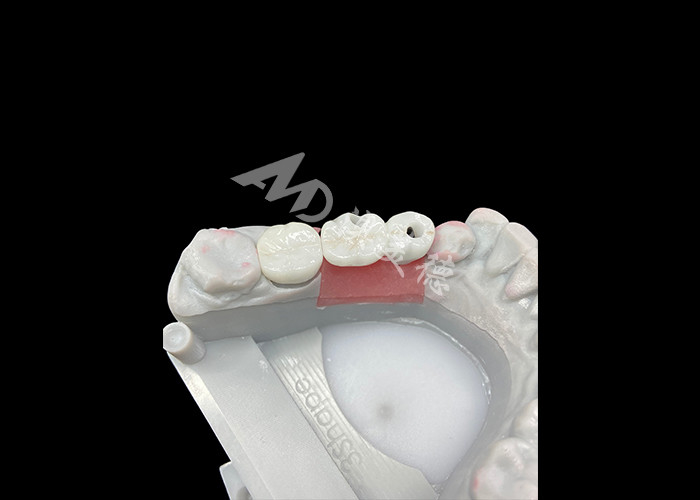 Des couronnes d'implants dentaires en zirconium avec un support en titane pour un confort et une esthétique améliorés