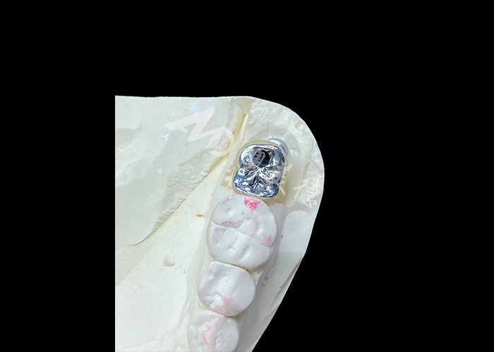 Une couronne d'implant dentaire en titane et une couronne en porcelaine fondue en métal