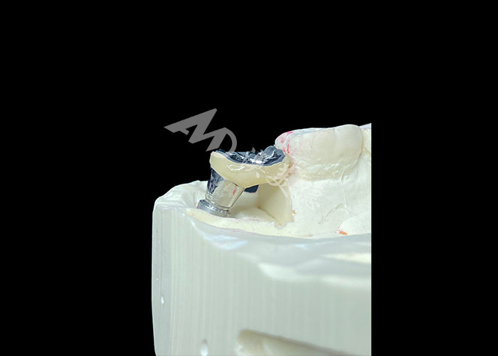 Une couronne d'implant dentaire en titane et une couronne en porcelaine fondue en métal