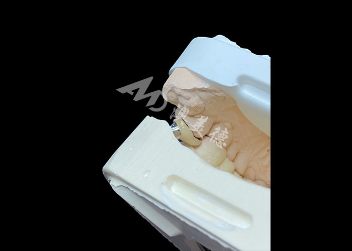 Une couronne d'implant dentaire en titane et une couronne en porcelaine fondue en métal