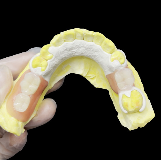Prothèse dentaire partielle amovible esthétique sur mesure Cadre HPP pour le remplacement partiel des dents naturelles