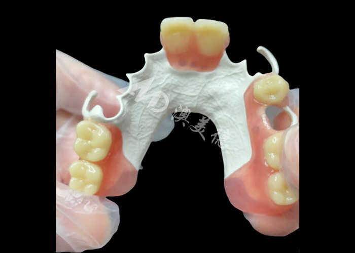 Prothèse dentaire partielle amovible esthétique sur mesure Cadre HPP pour le remplacement partiel des dents naturelles