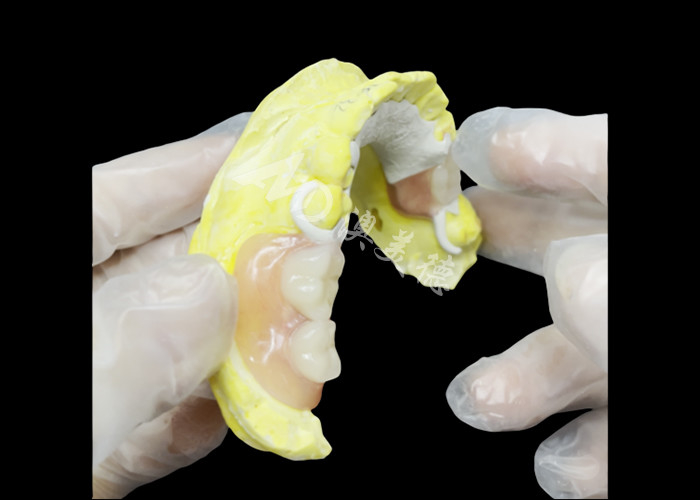 Prothèse partielle coulée sur mesure avec cadre HPP pour une meilleure mastication et une meilleure parole