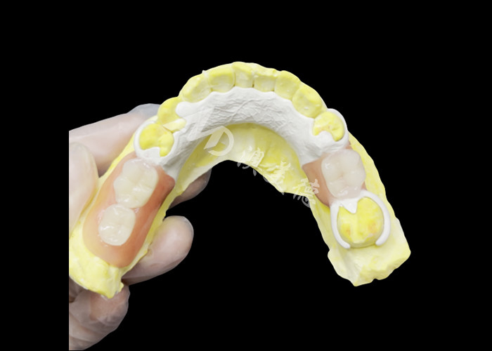 Prothèse partielle coulée sur mesure avec cadre HPP pour une meilleure mastication et une meilleure parole