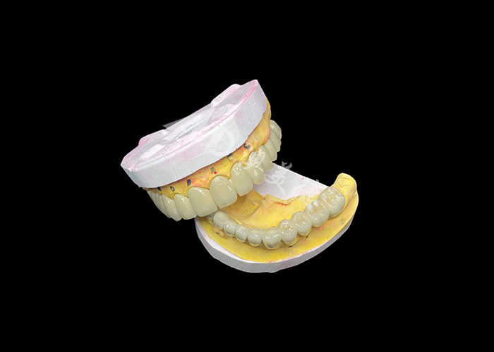 Porcelaine personnalisée fusionnée à un pont de couronne dentaire métallique pour améliorer le sourire naturel