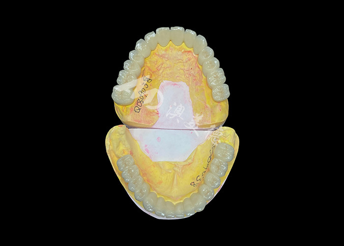 Porcelaine personnalisée fusionnée à un pont de couronne dentaire métallique pour améliorer le sourire naturel