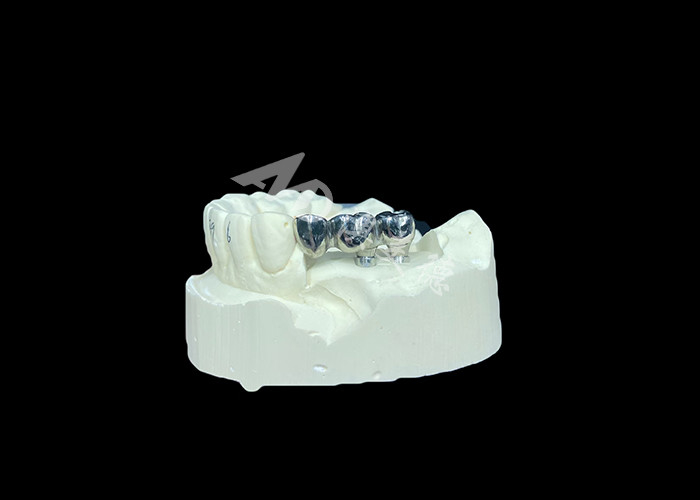Implantation dentaire en titane à couronne de plâtre à longue durée de vie pour remplacer les dents manquantes