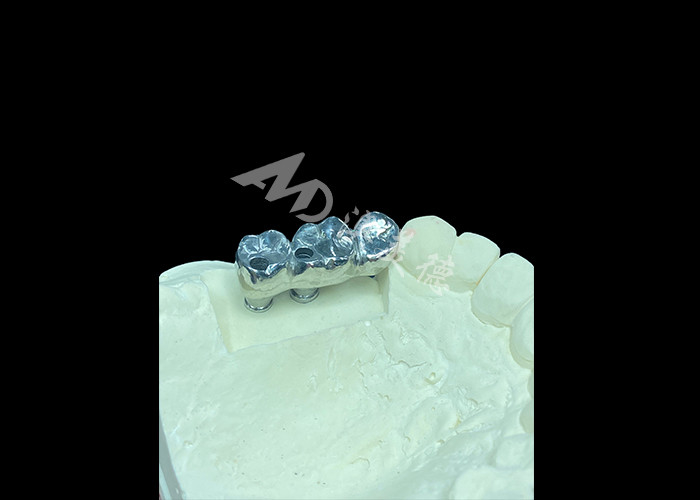 Implantation dentaire en titane à couronne de plâtre à longue durée de vie pour remplacer les dents manquantes