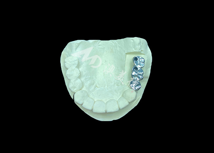 Implantation dentaire en titane à couronne de plâtre à longue durée de vie pour remplacer les dents manquantes