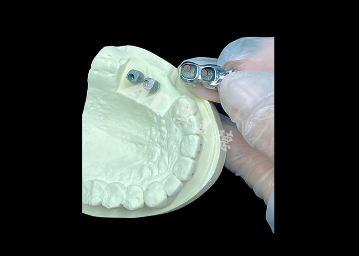 Implantation dentaire en titane à couronne de plâtre à longue durée de vie pour remplacer les dents manquantes