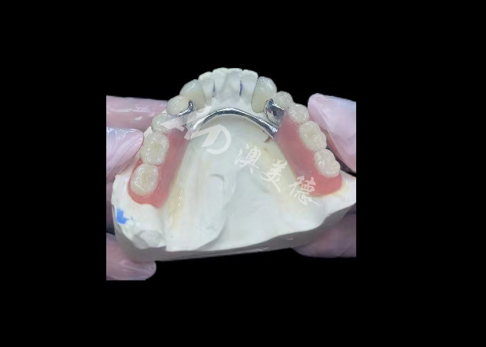 Porcelaine durable fondue dans du métal couronne dentaire PFM couronne pour la restauration