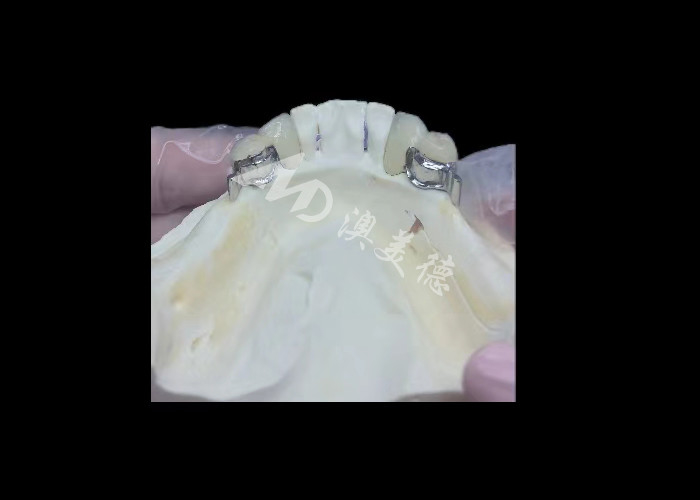 Porcelaine durable fondue dans du métal couronne dentaire PFM couronne pour la restauration