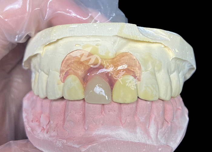 Prothèse partielle flexible Nesbit pour incisives offrant une solution de remplacement dentaire amovible sans couture