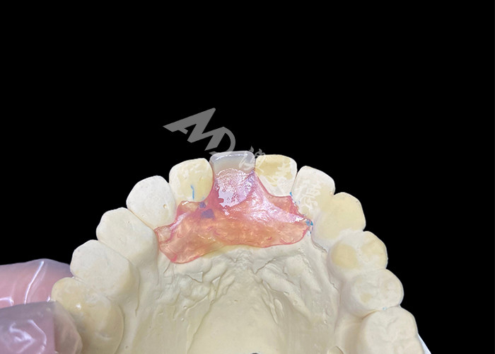 Prothèse partielle flexible Nesbit pour incisives offrant une solution de remplacement dentaire amovible sans couture