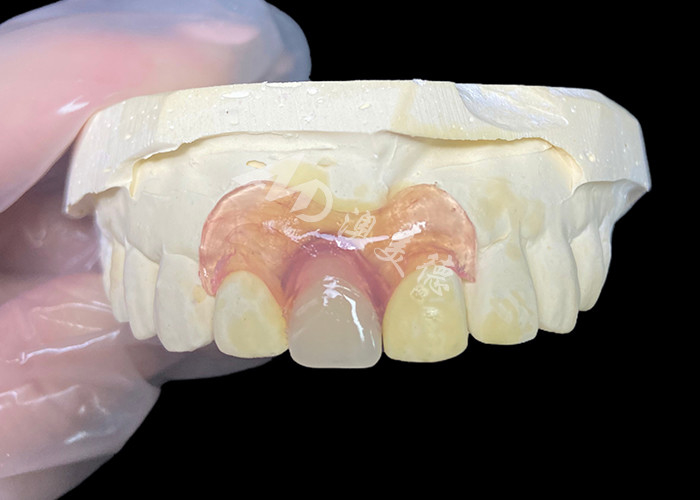 Prothèse partielle flexible Nesbit pour incisives offrant une solution de remplacement dentaire amovible sans couture