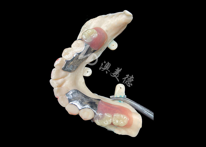 Dentures partielles coulées personnalisées cadre métallique de précision pour un ajustement et une fonctionnalité optimaux