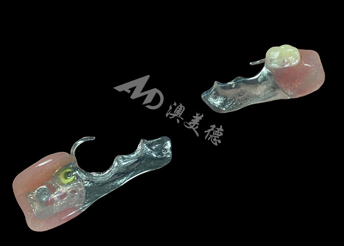 Dentures partielles coulées personnalisées cadre métallique de précision pour un ajustement et une fonctionnalité optimaux