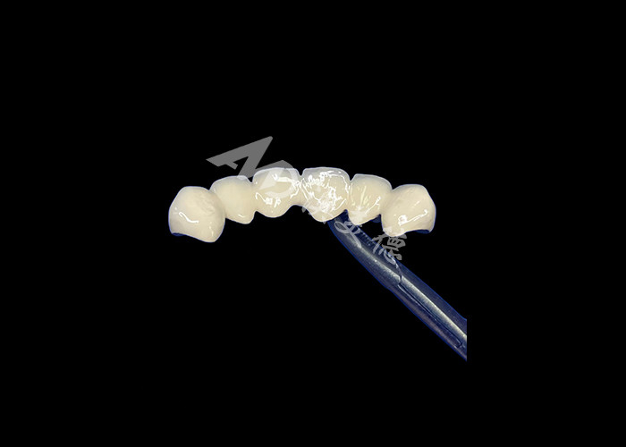 Porcelaine biocompatible fusionnée à une couronne métallique haute durabilité pour une restauration améliorée
