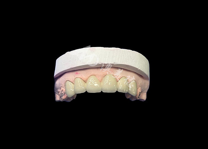 Porcelaine biocompatible fusionnée à une couronne métallique haute durabilité pour une restauration améliorée