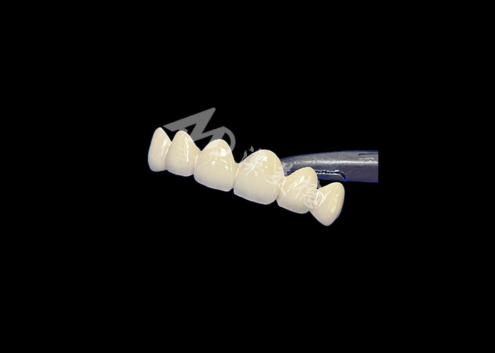 Porcelaine biocompatible fusionnée à une couronne métallique haute durabilité pour une restauration améliorée