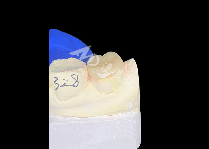IPS E.max Inlays en céramique Onlays mélanger sans couture naturel et durable avec vos dents