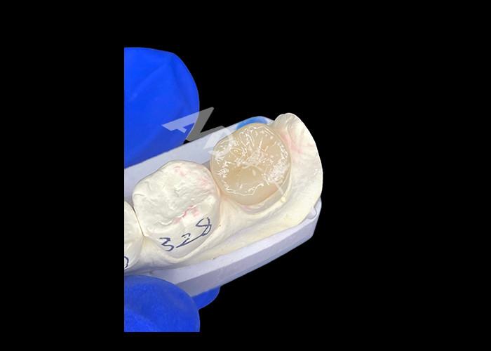 IPS E.max Inlays en céramique Onlays mélanger sans couture naturel et durable avec vos dents