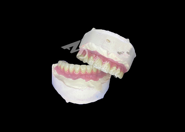 Dentistique Tout-sur-6 Prothèses dentaires à support d'implant dentaire avec stabilité et confort