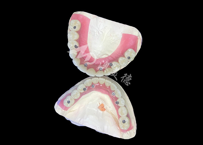 Dentistique Tout-sur-6 Prothèses dentaires à support d'implant dentaire avec stabilité et confort