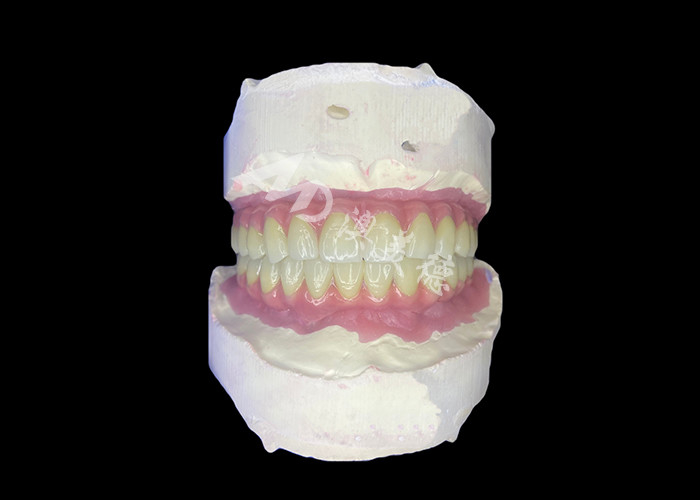 Dentistique Tout-sur-6 Prothèses dentaires à support d'implant dentaire avec stabilité et confort