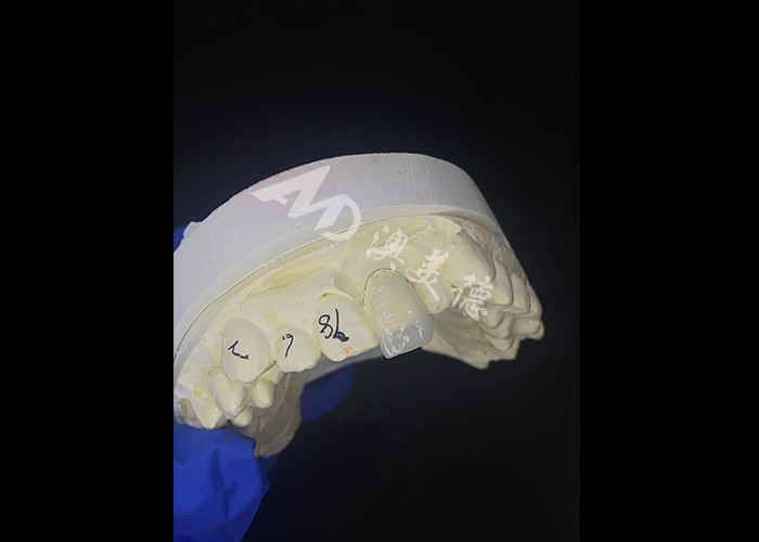 IPS e.max Veneurs pour incisif à l'ombre A1 Esthétique naturelle pour un sourire parfait