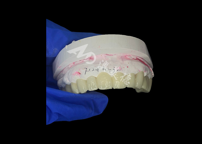 Pont dentaire en zirconium à haute translucide Forte et naturelle pour une restauration du sourire sans couture