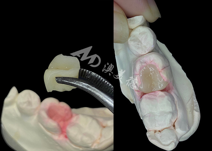 IPS e.max Inlay et Onlay en céramique pour la restauration dentaire à l'aspect naturel