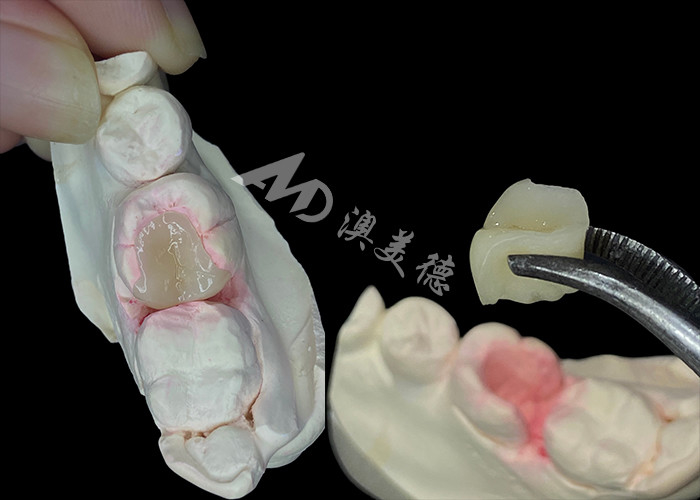 IPS e.max Inlay et Onlay en céramique pour la restauration dentaire à l'aspect naturel