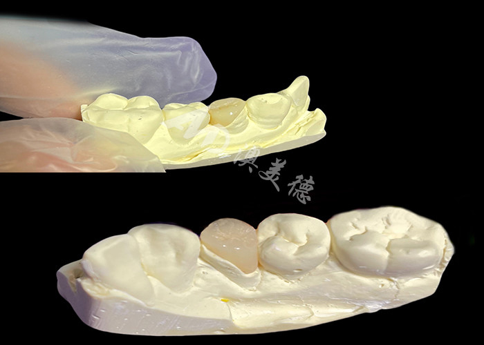 IPS e.max Inlay et Onlay en céramique pour la restauration dentaire à l'aspect naturel