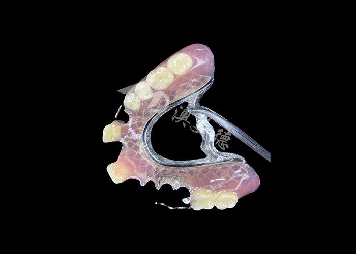Prothèses partielles coulées personnalisables pour une durabilité et un confort de précision lors du remplacement partiel des dents