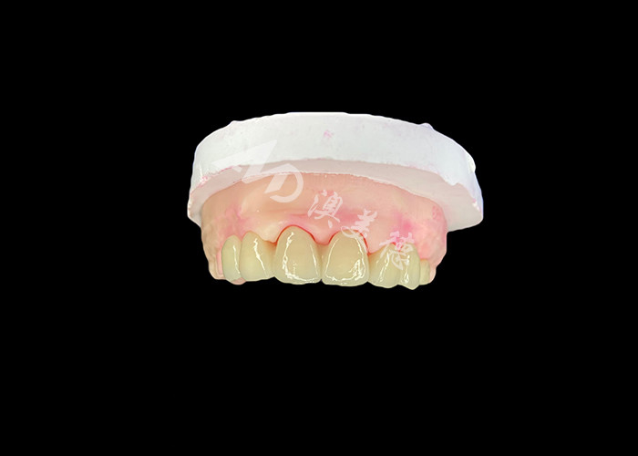 Wieland Zenostar Ceramic Crown Bridge haute précision pour des restaurations durables et naturelles