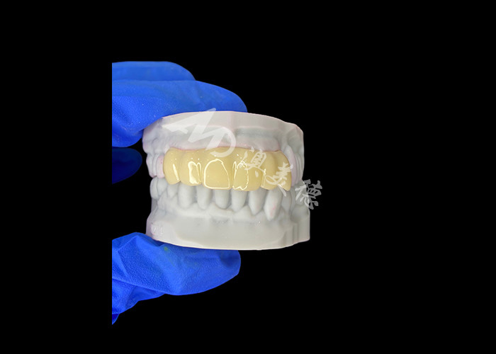 Pont temporaire creux imprimé 3D biocompatible léger pour les réparations préimplantatoires