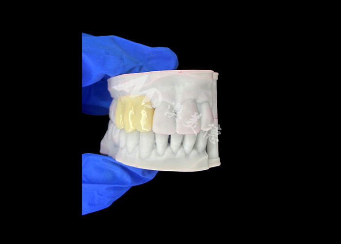 Pont temporaire creux imprimé 3D biocompatible léger pour les réparations préimplantatoires