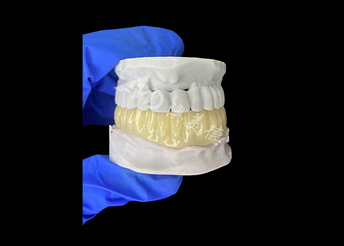 Pont temporaire creux imprimé 3D biocompatible léger pour les réparations préimplantatoires